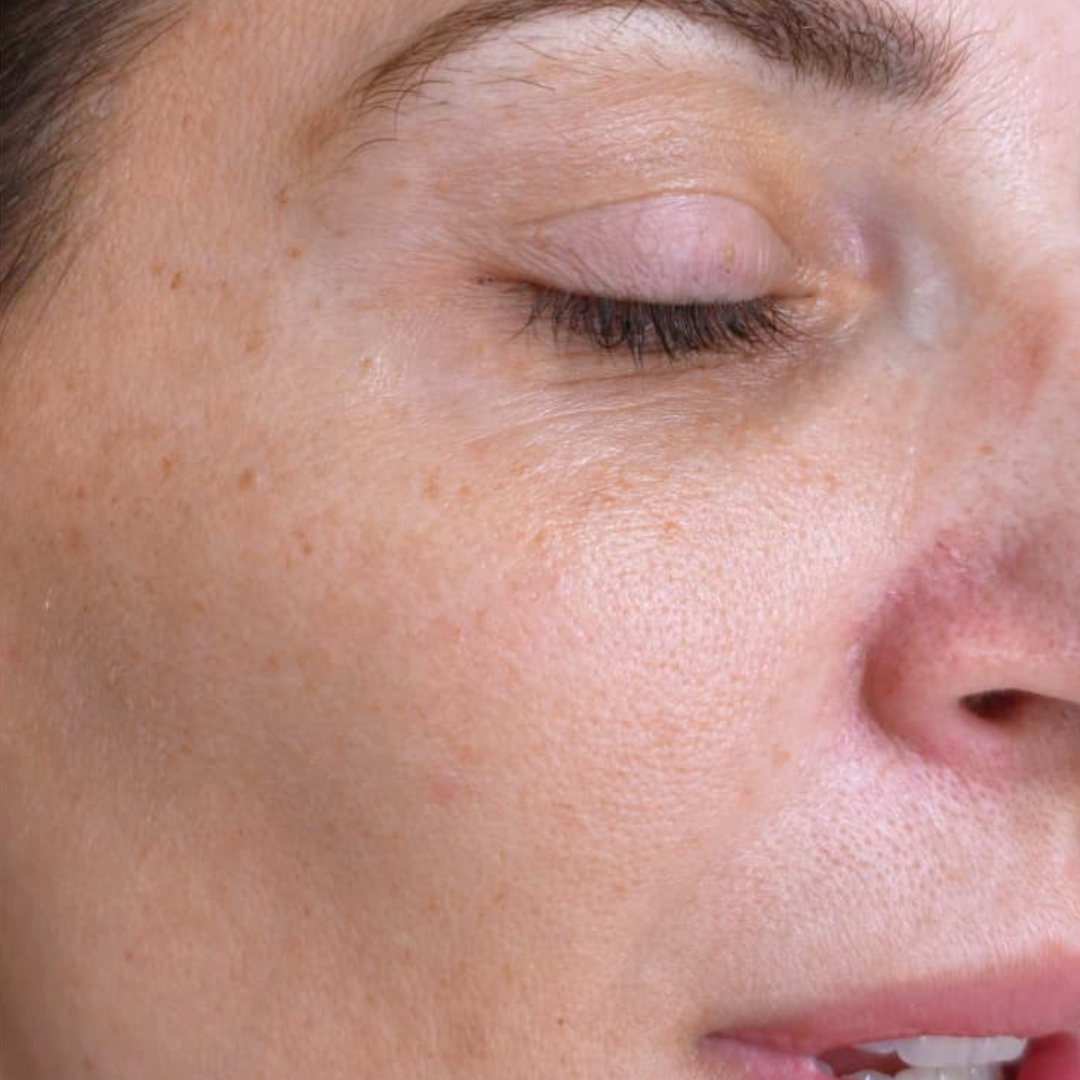 After Nd:YAG Pico Rejuvenation