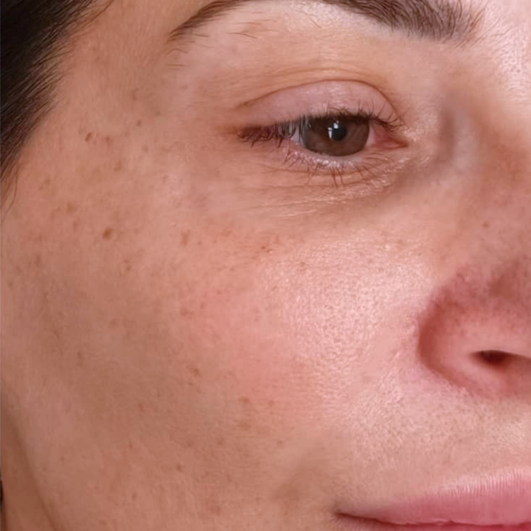 Before Nd:YAG Pico Rejuvenation