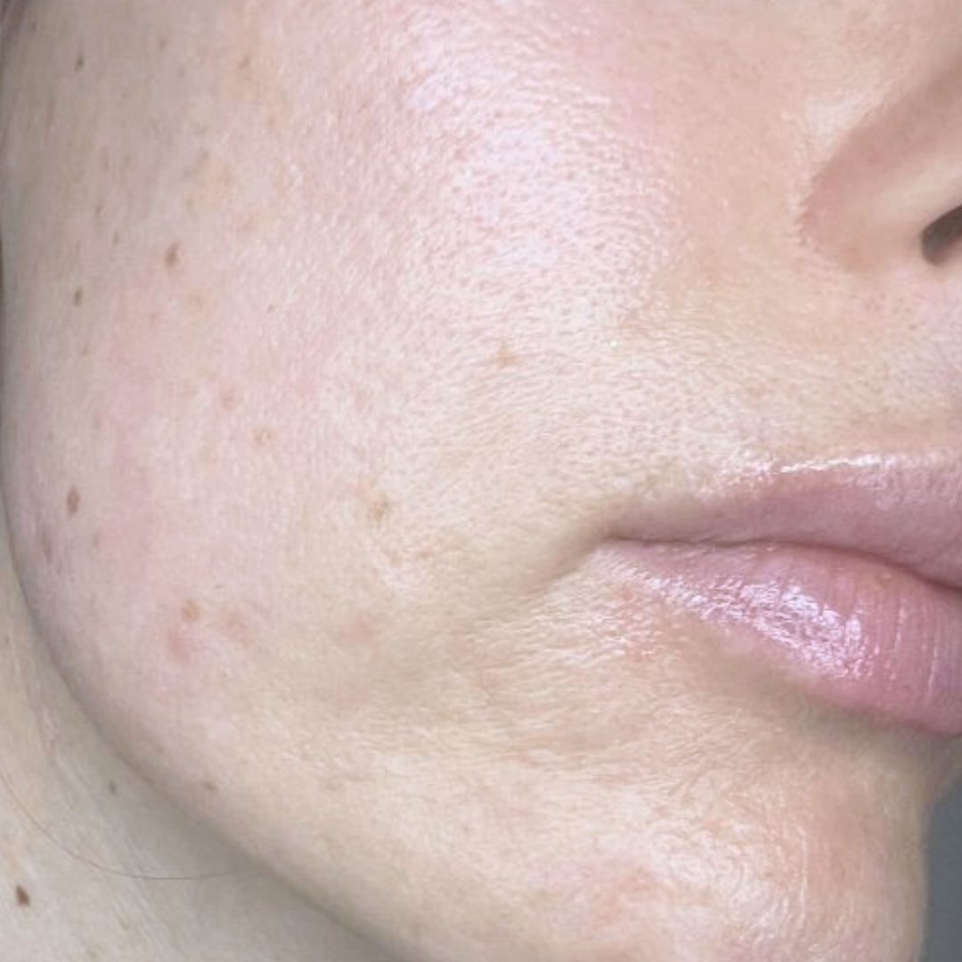 After Nd:YAG Pico Rejuvenation