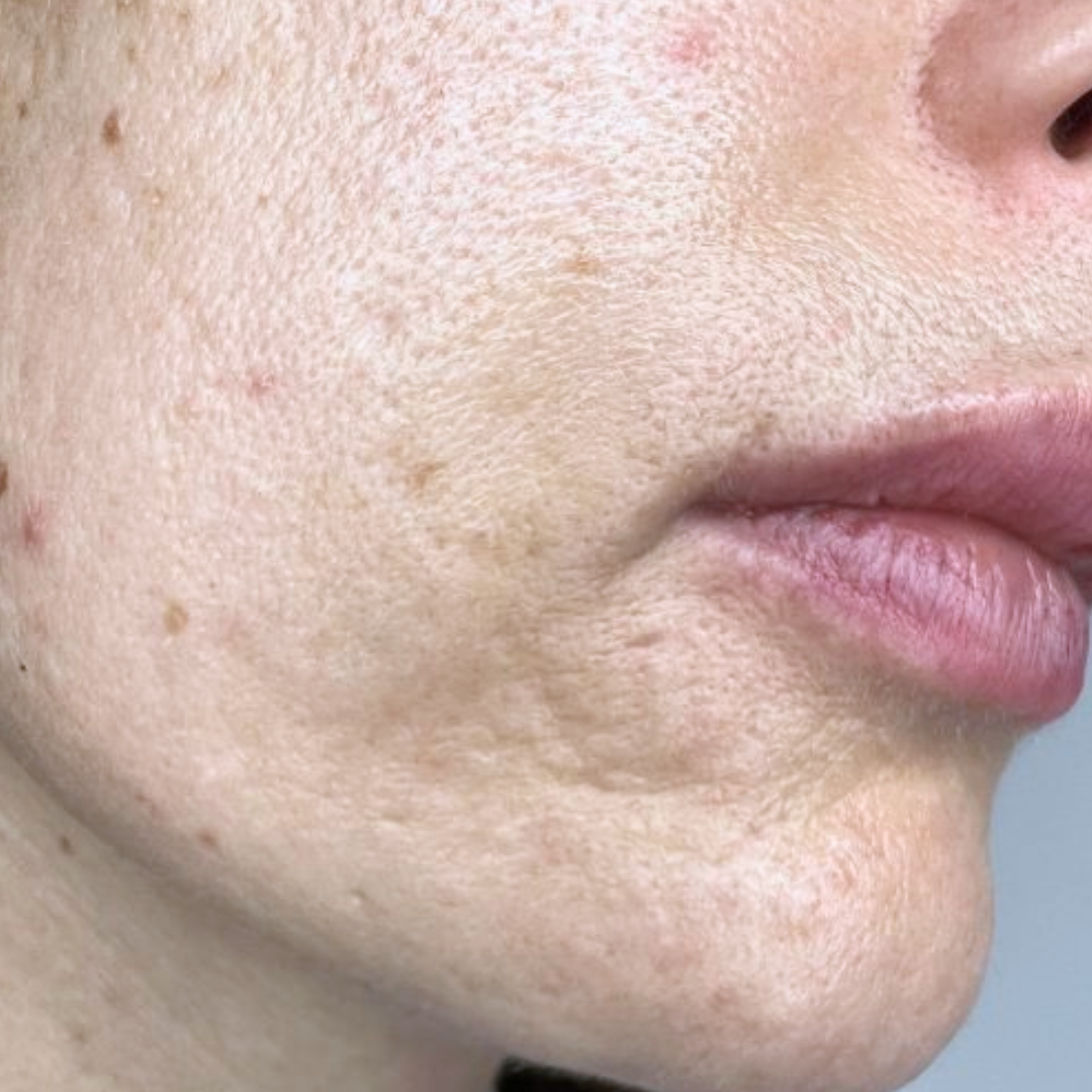 Before Nd:YAG Pico Rejuvenation